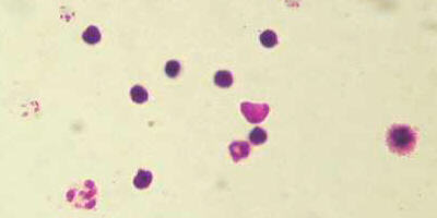 Plasmodium vivax in RBCs