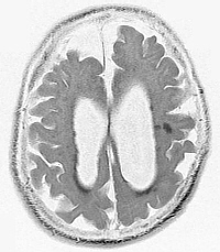 Brain Degeneration