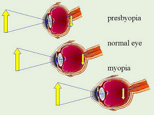 Sightedness